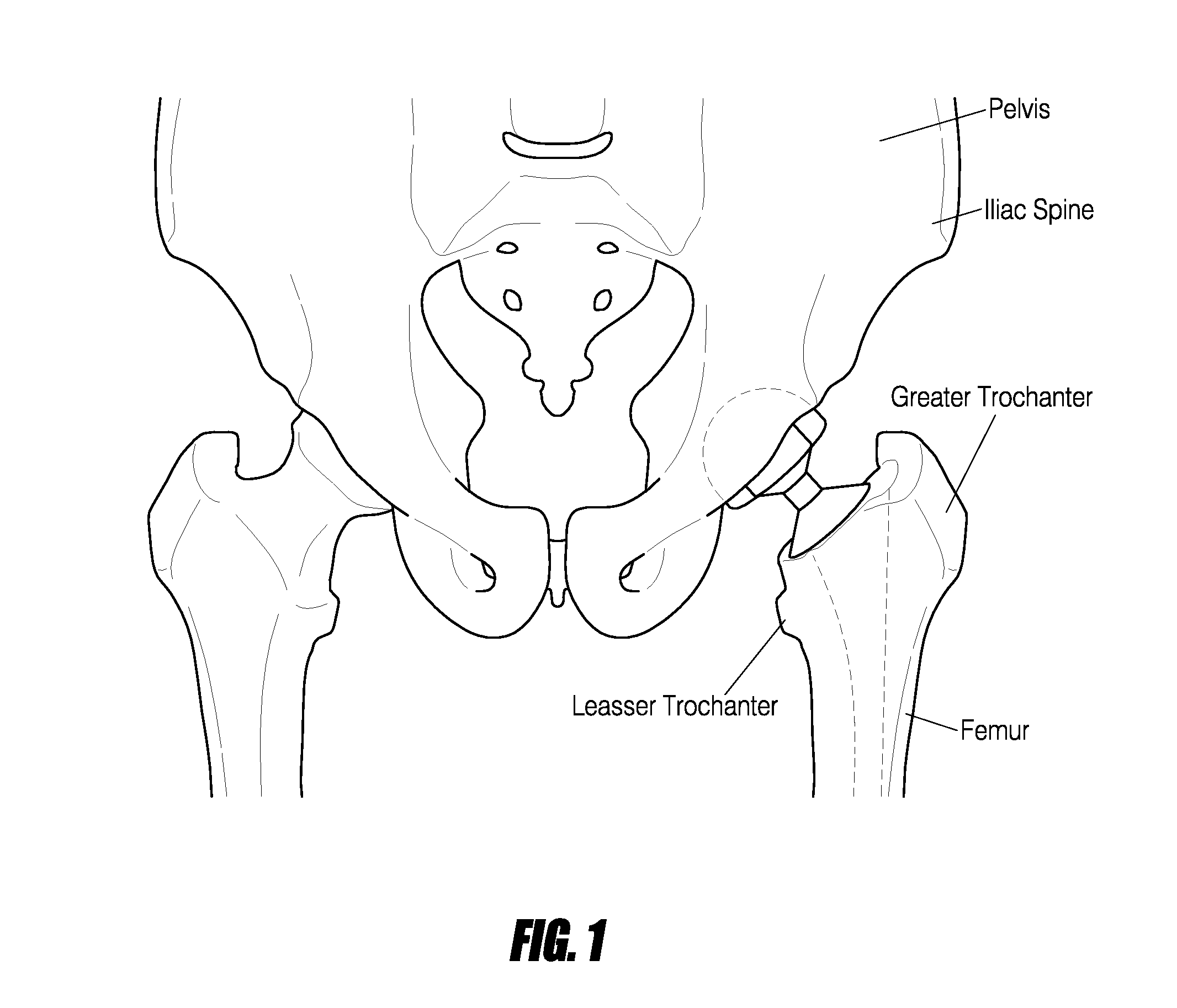 Hip surgery systems and methods