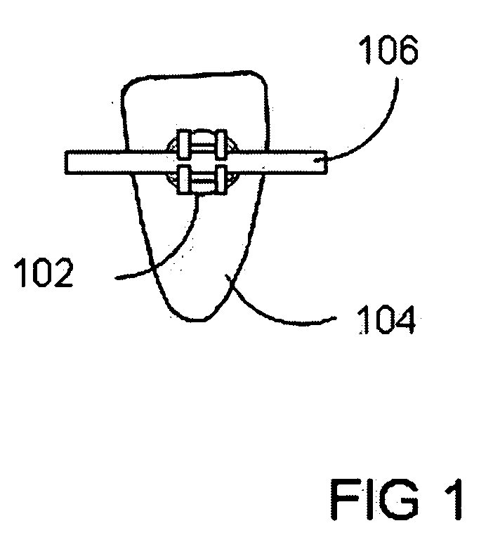 System and method for orthodontic retention