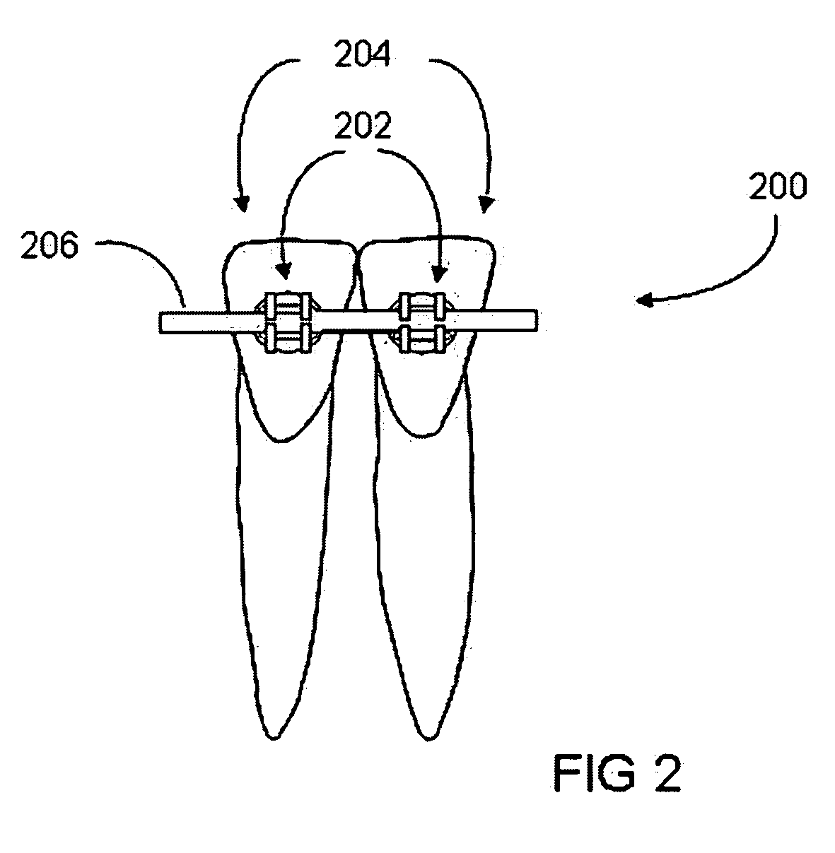 System and method for orthodontic retention