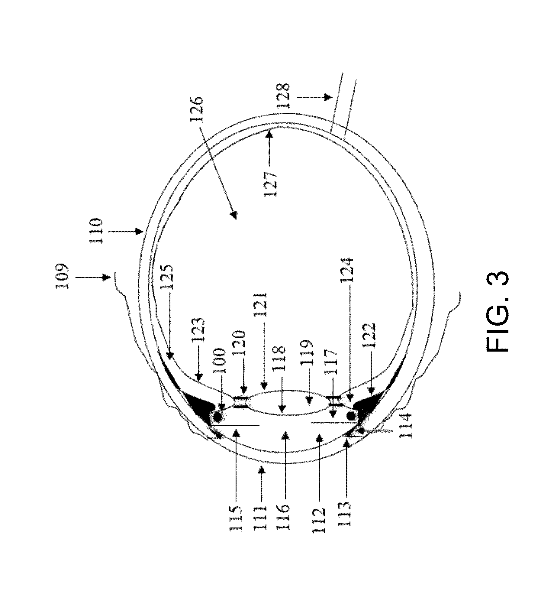 Device and method for ciliary muscle compression for increaseing the amplitude of accommodation