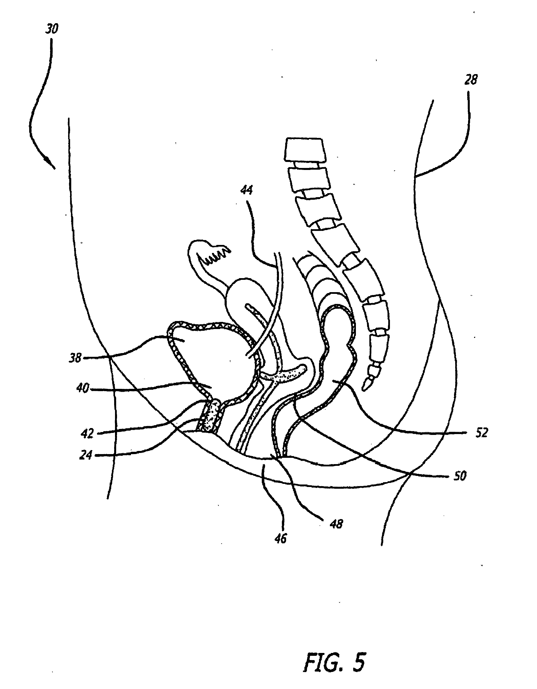 Transluminal drug delivery methods and devices