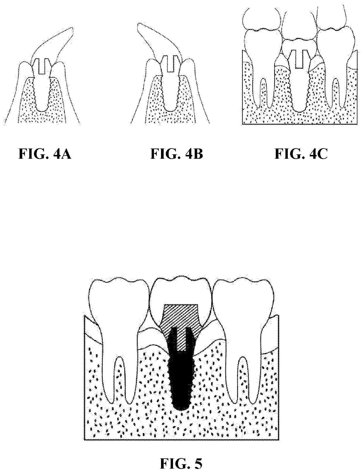 Integral-type implant