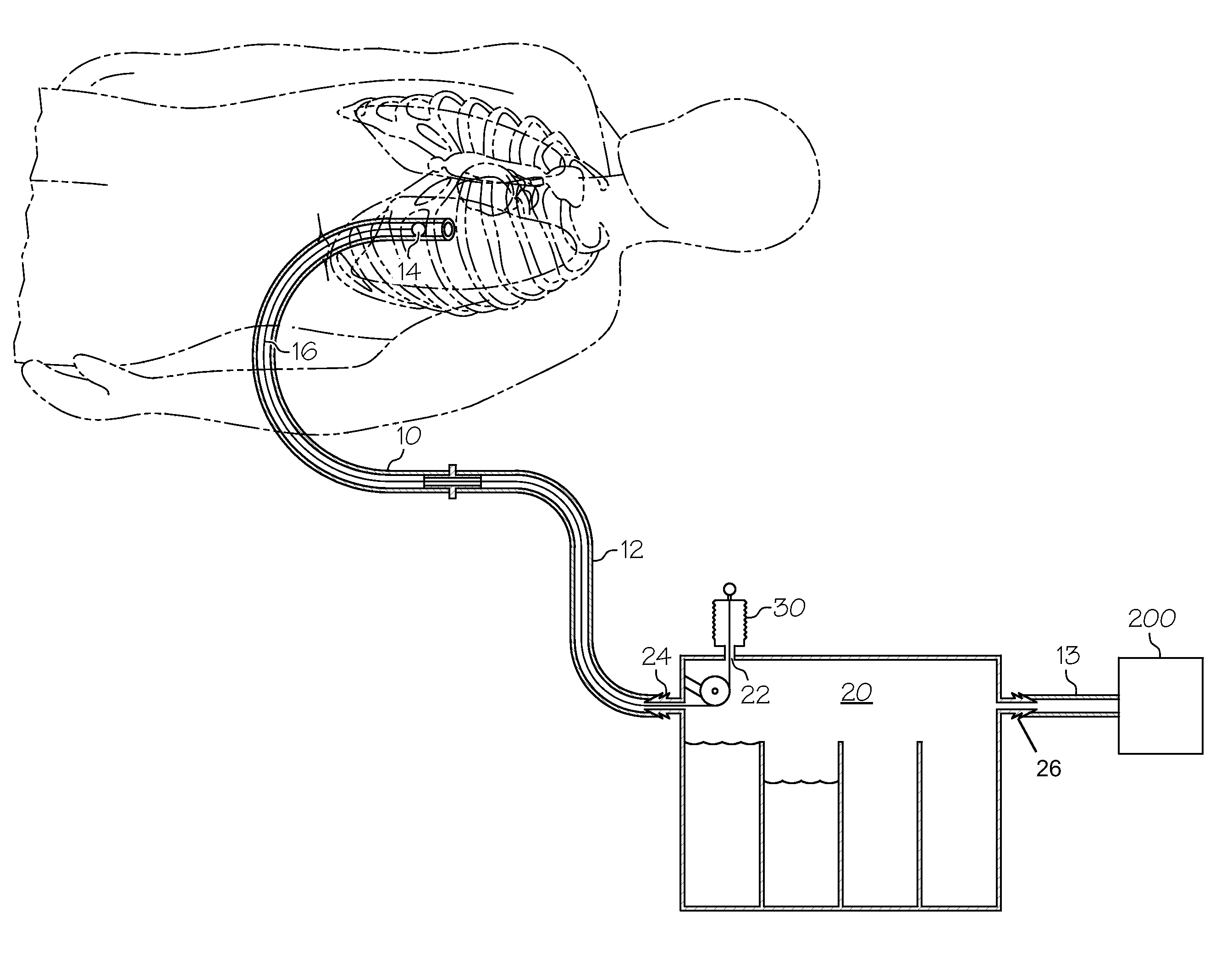 Methods and devices to clear obstructions from medical tubes