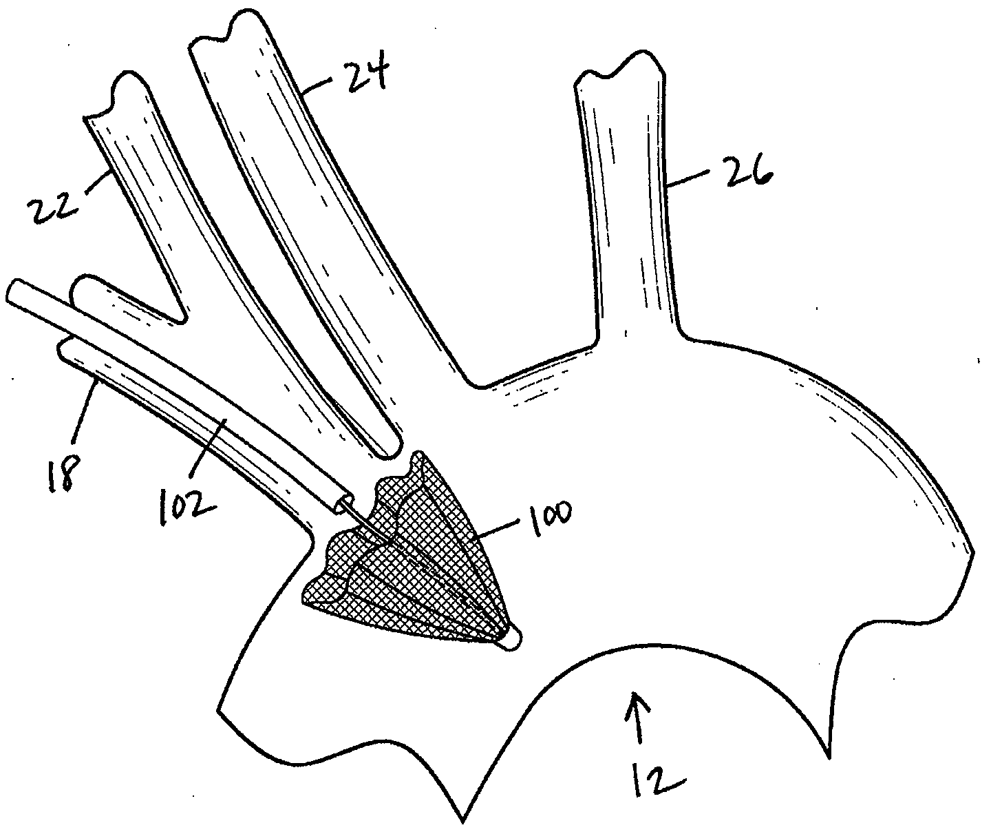 Methods of diverting embolic debris away from the cerebral circulation