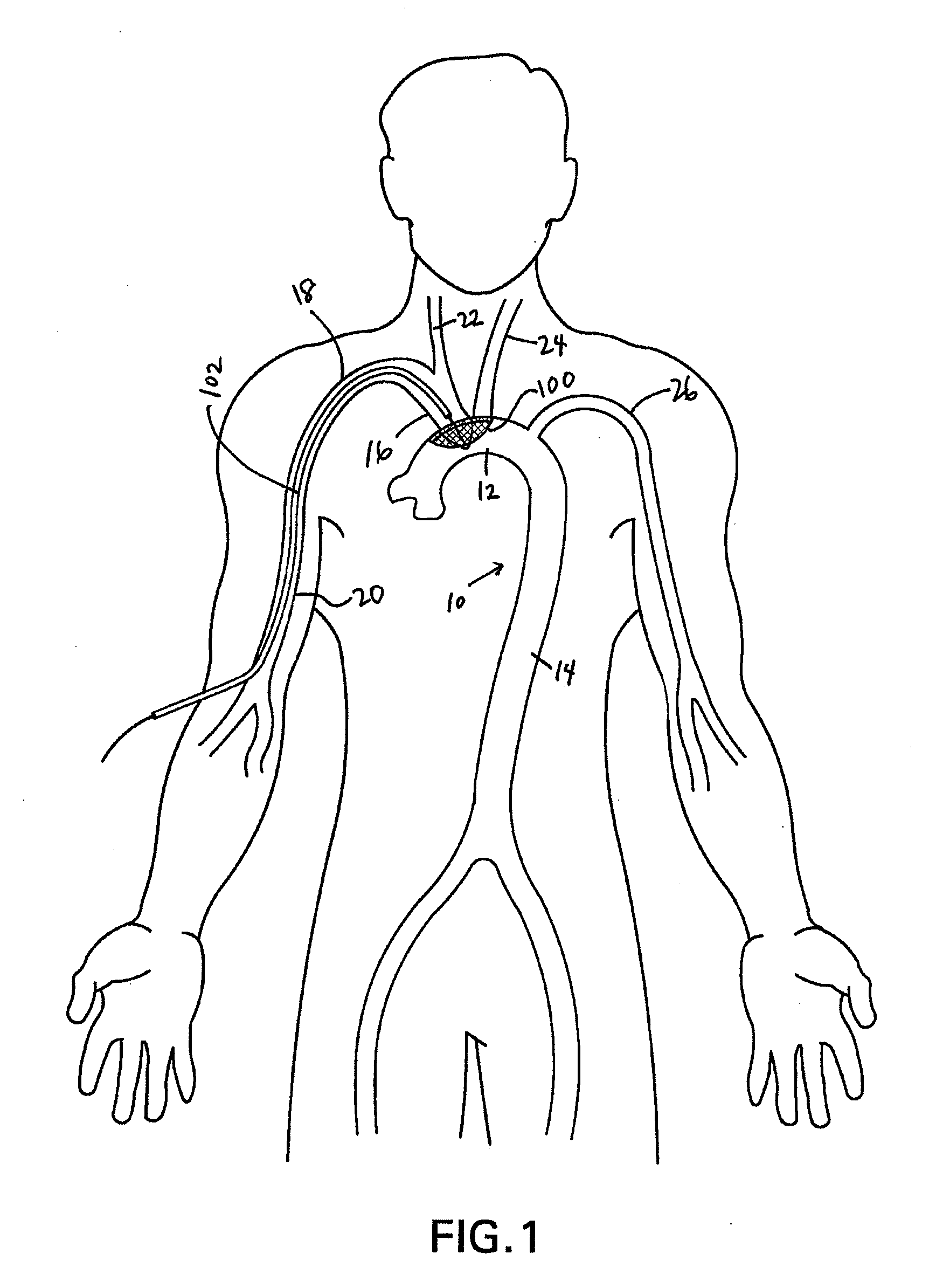 Methods of diverting embolic debris away from the cerebral circulation