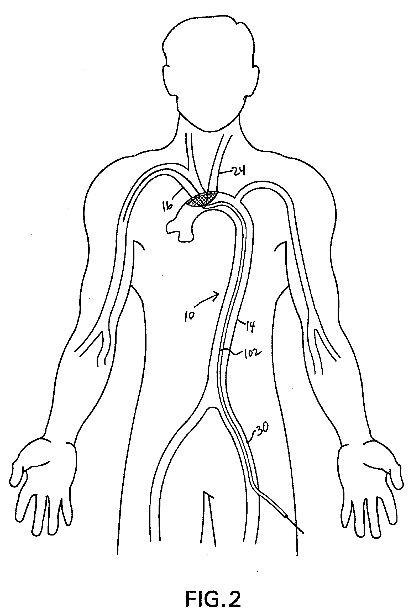 Methods of diverting embolic debris away from the cerebral circulation