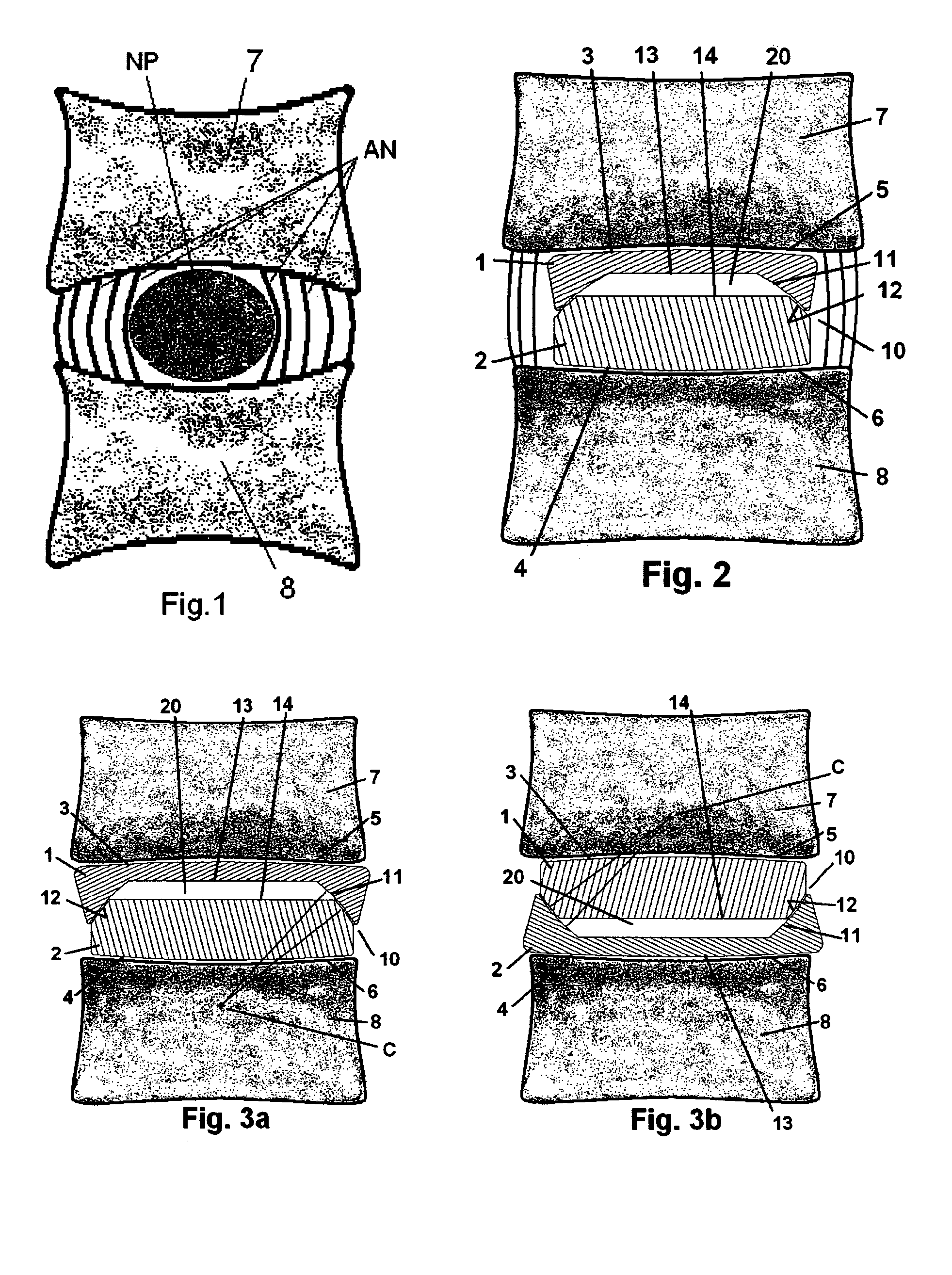 Prosthesis for nucleus or inter-vertebral disc replacement