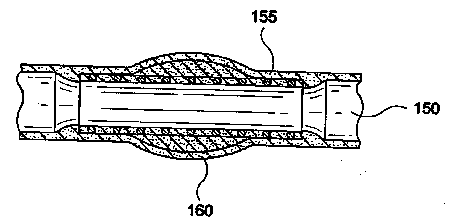 Stent-graft with bioabsorbable structural support