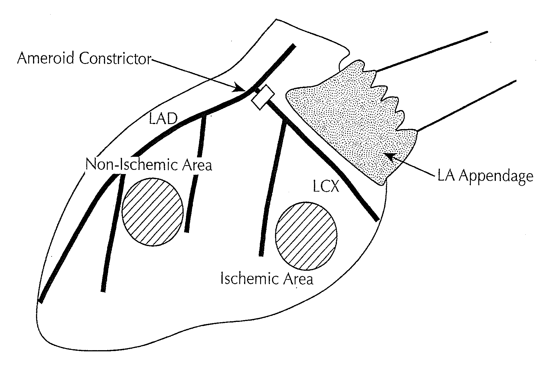 Localized myocardial injection method for treating ischemic myocardium