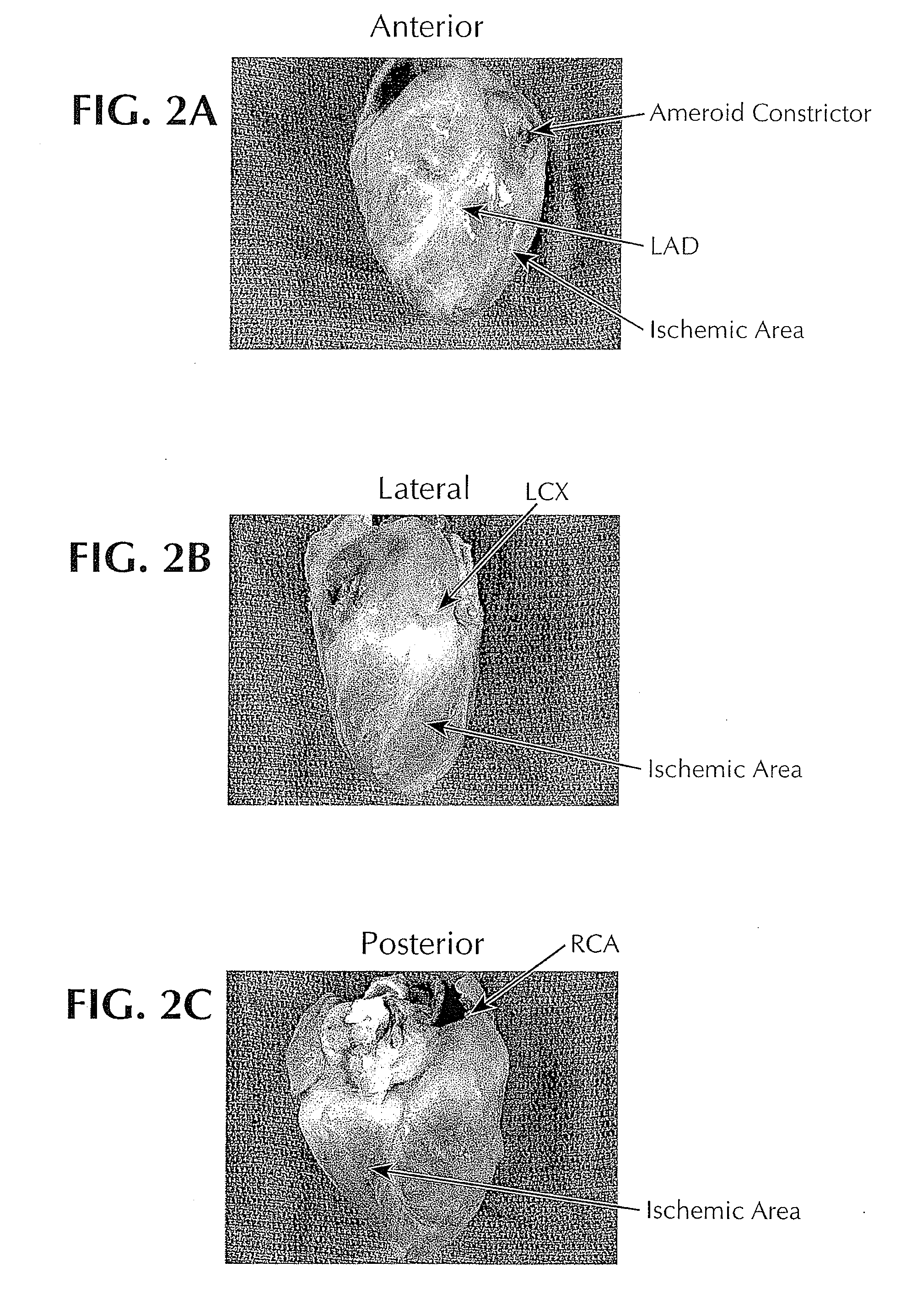 Localized myocardial injection method for treating ischemic myocardium