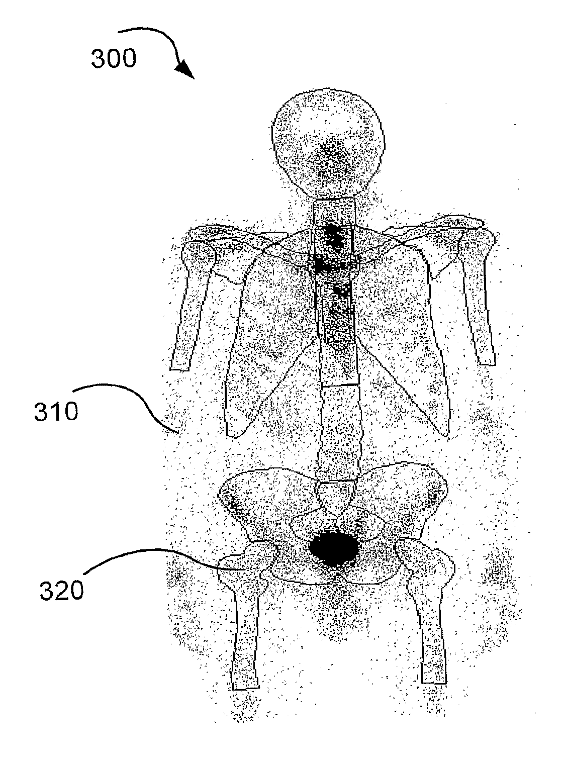 System for detecting bone cancer metastases