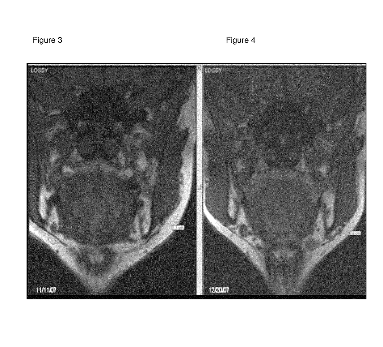 Medicinal cosmetic lipoatrophy