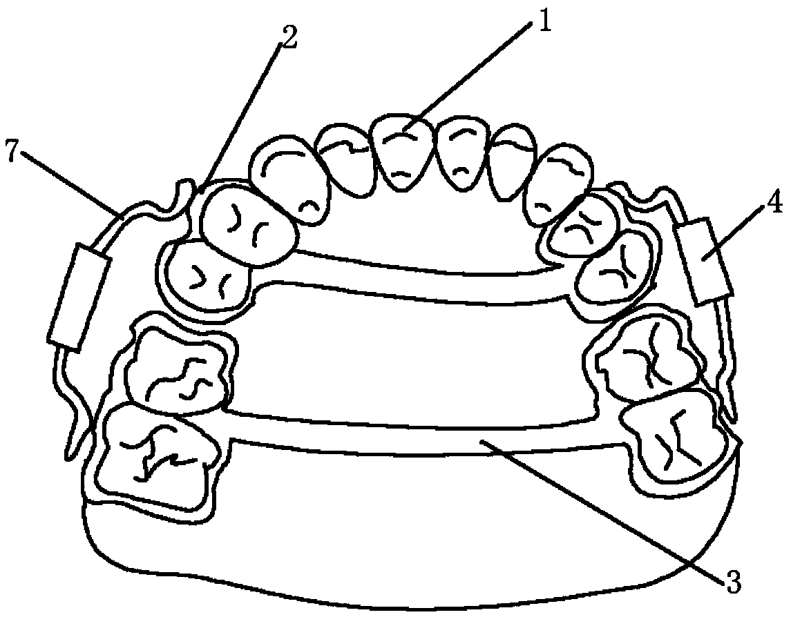 Maxillary built-in sagittal distraction osteogenesis device