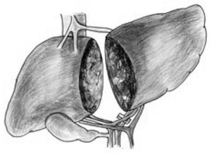 Surgical method and instrument for two-step excision of patient side liverby liver winding belt method under complete laparoscope