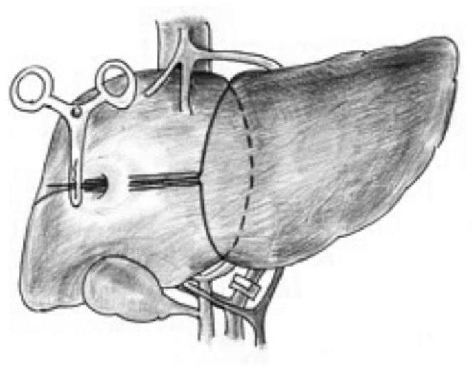 Surgical method and instrument for two-step excision of patient side liverby liver winding belt method under complete laparoscope