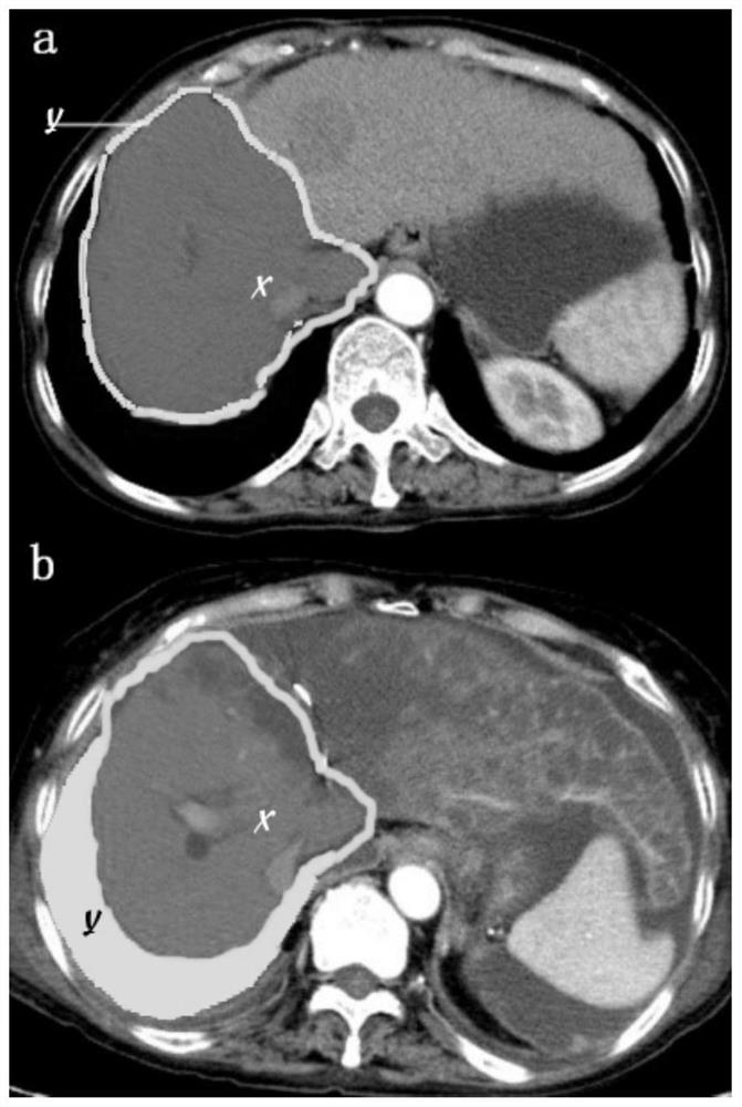 Surgical method and instrument for two-step excision of patient side liverby liver winding belt method under complete laparoscope