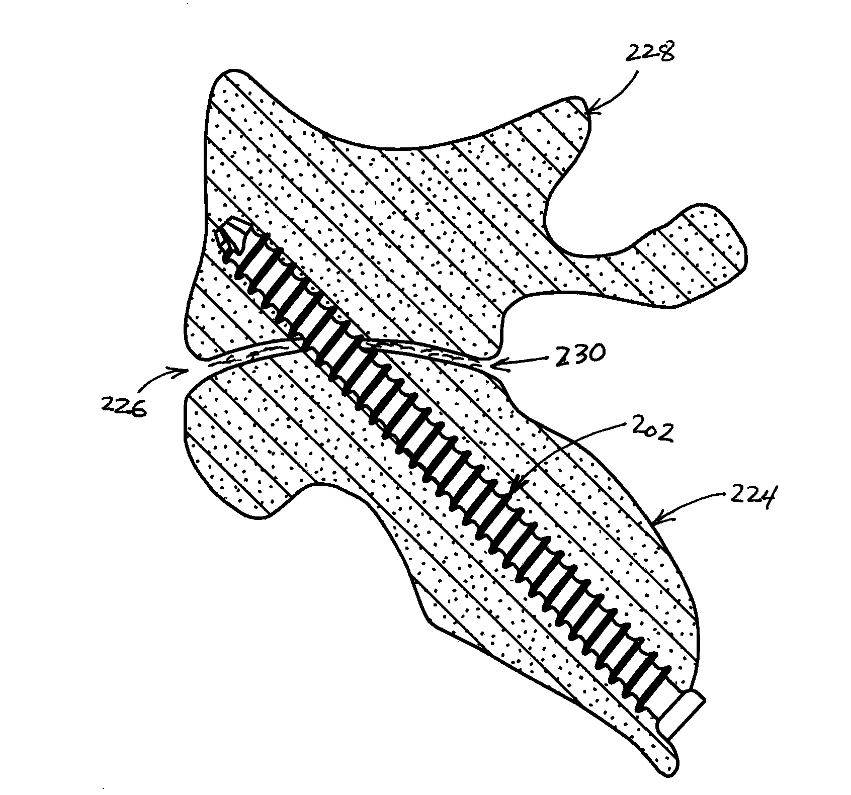 Bone Fixation Device and Methods for Use Thereof