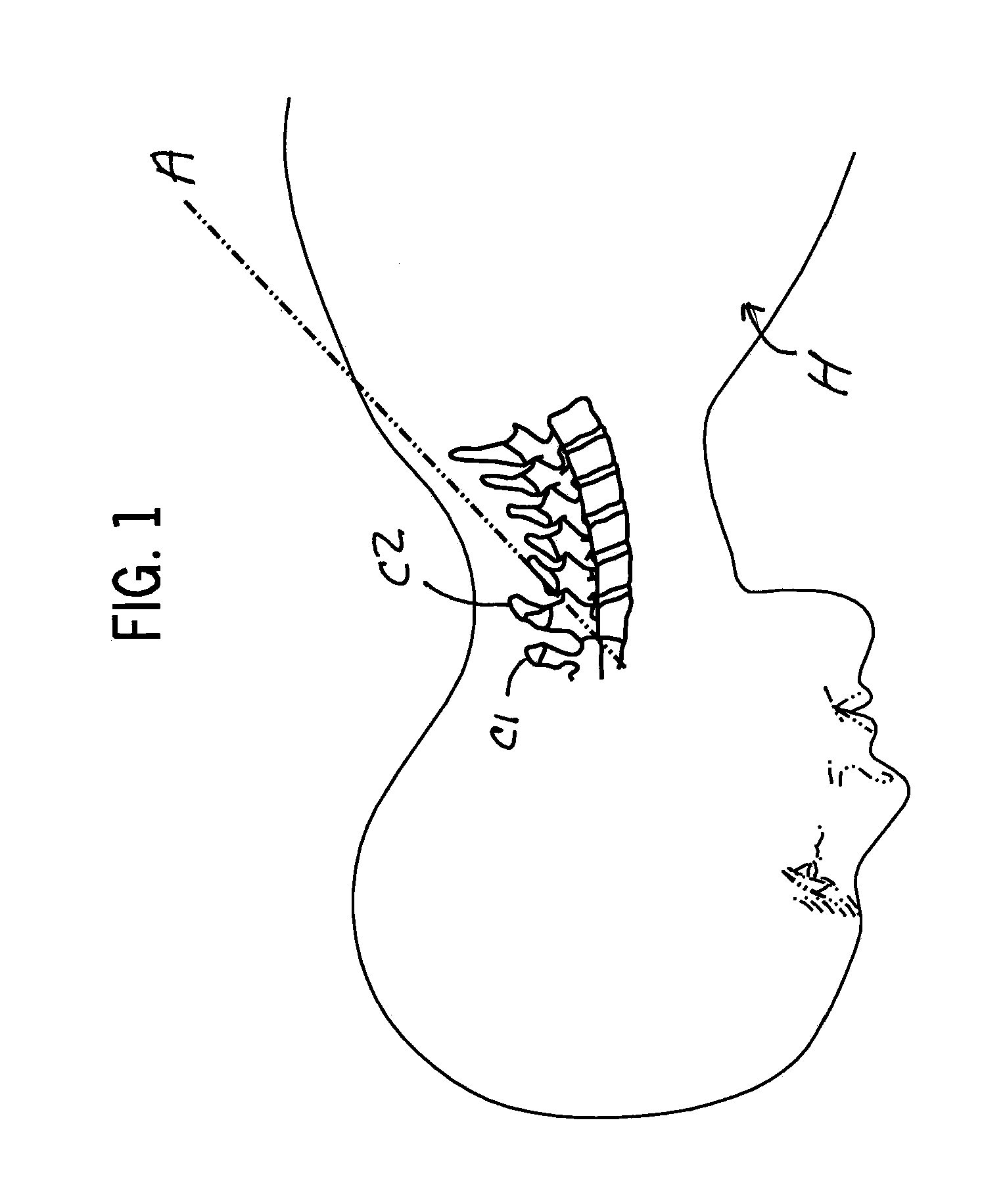 Bone Fixation Device and Methods for Use Thereof