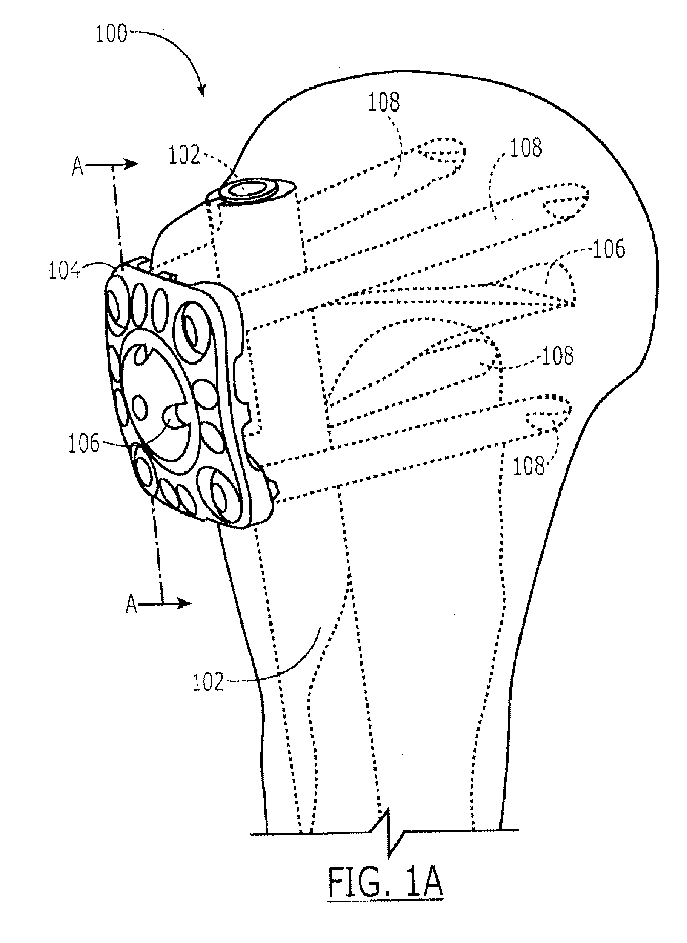 Nail-Plate Combination