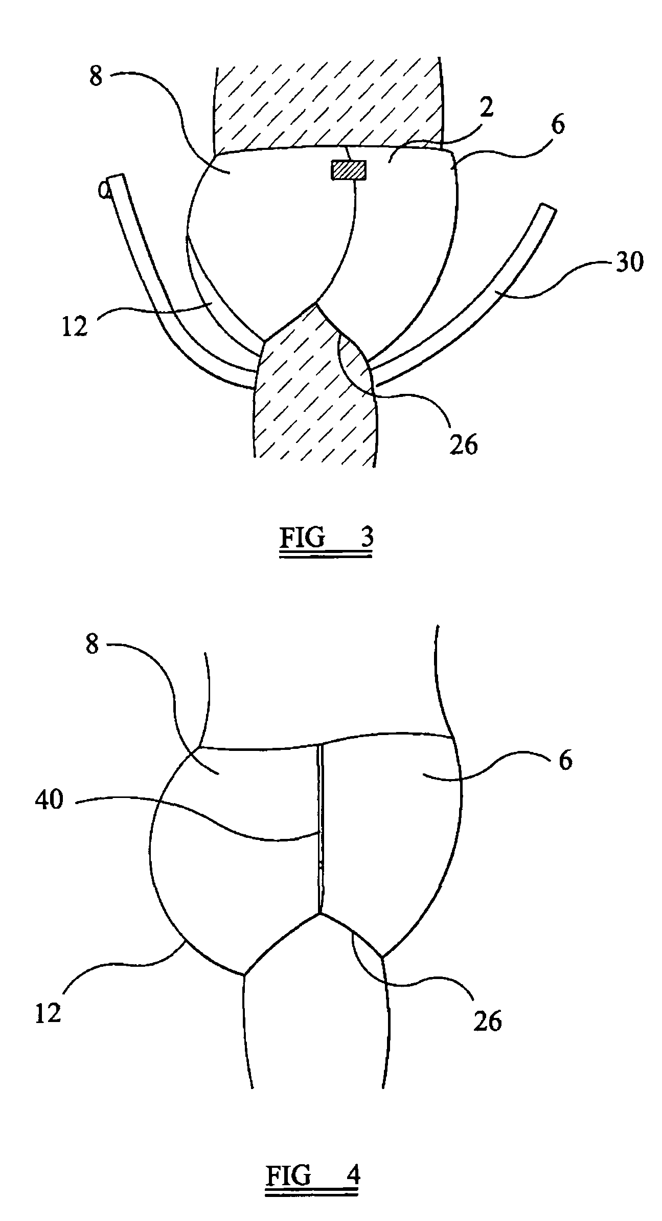 Disposable absorbent article with separate part