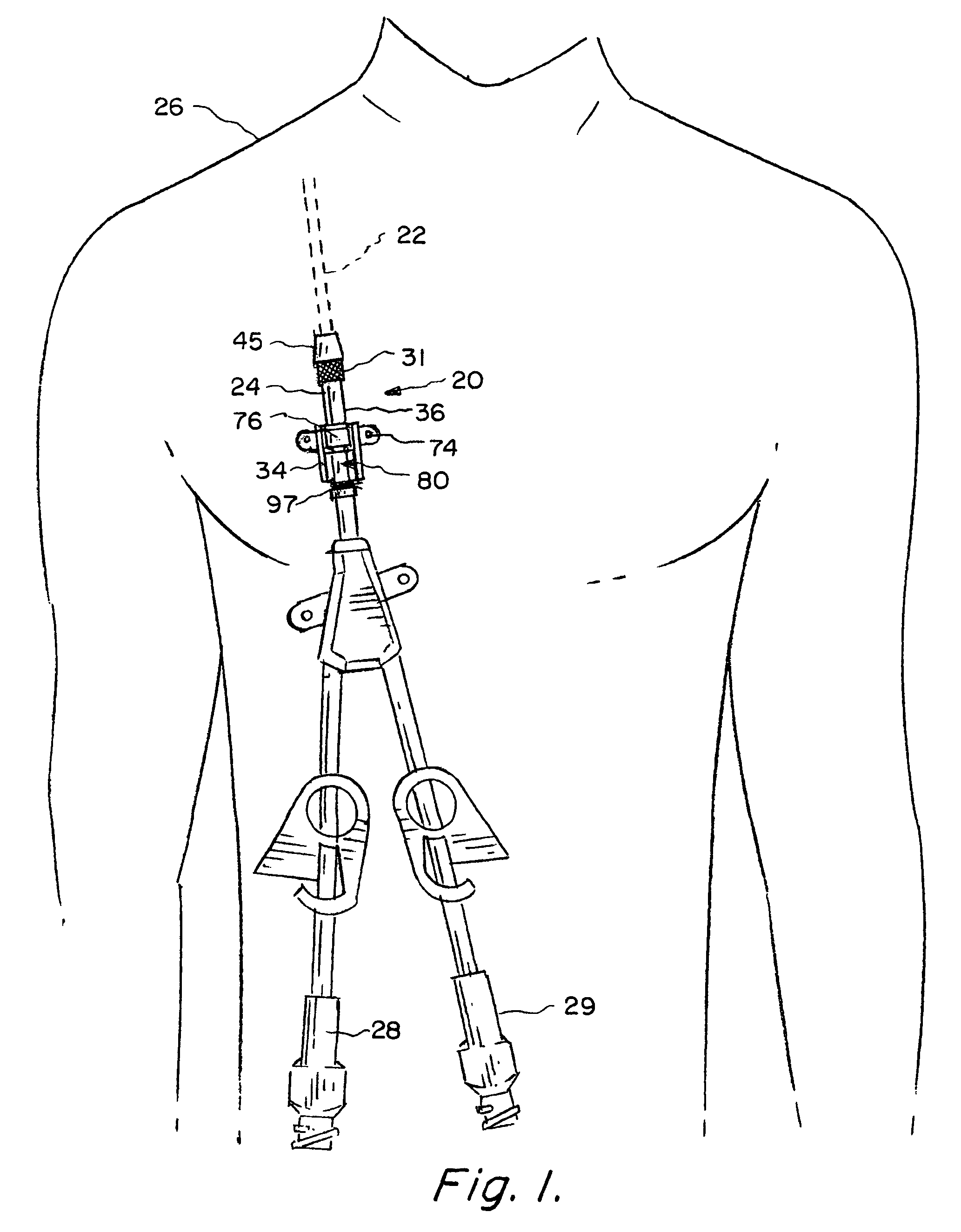 Enhanced apparatus for percutaneous catheter implantation and replacement