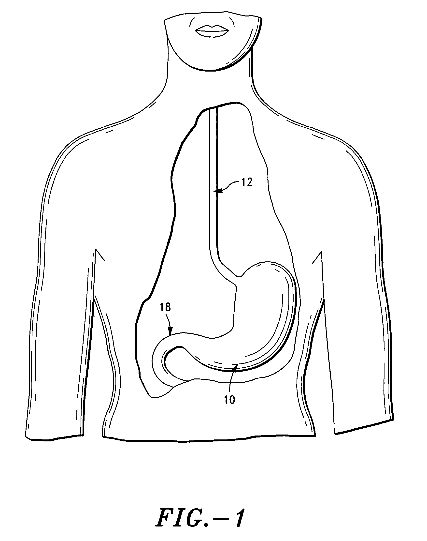 Method and system for treatment of eating disorders