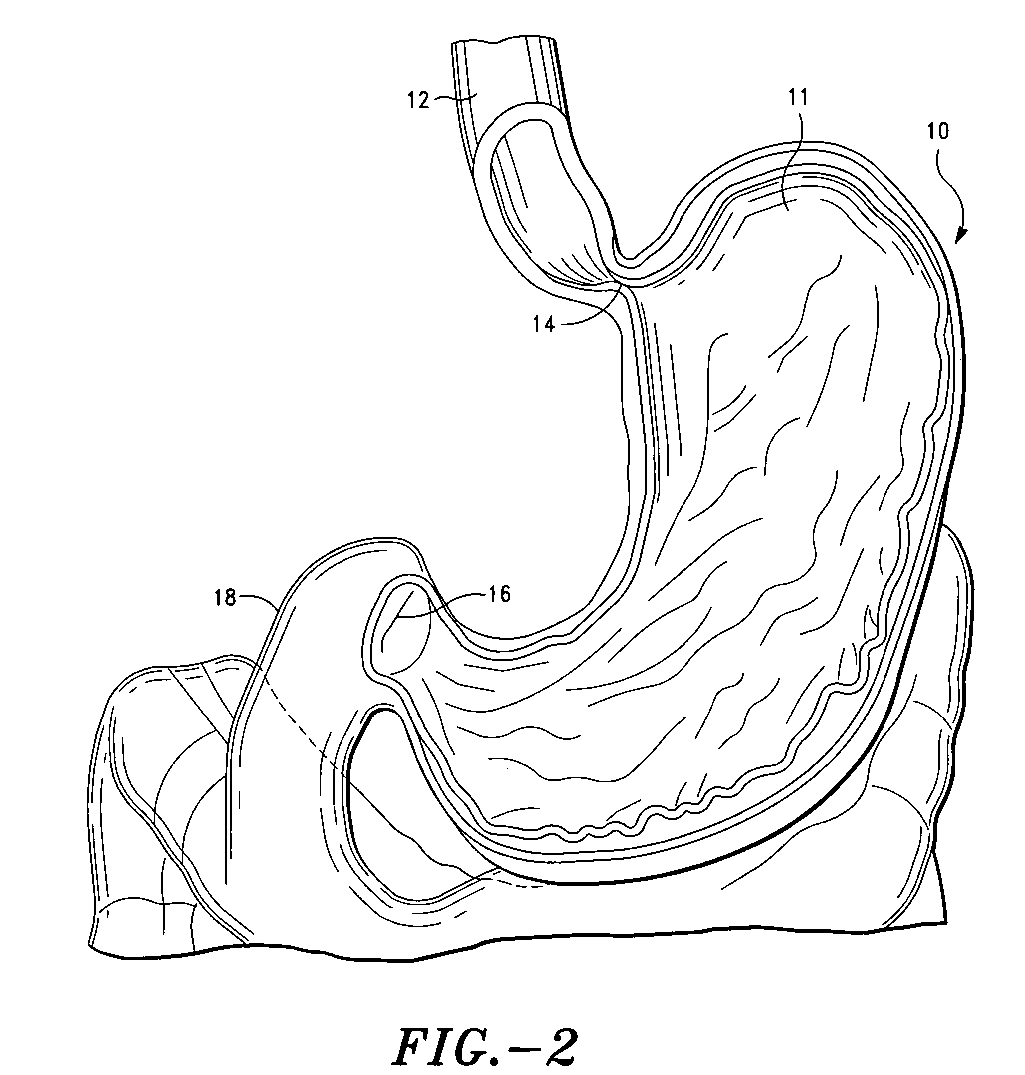 Method and system for treatment of eating disorders