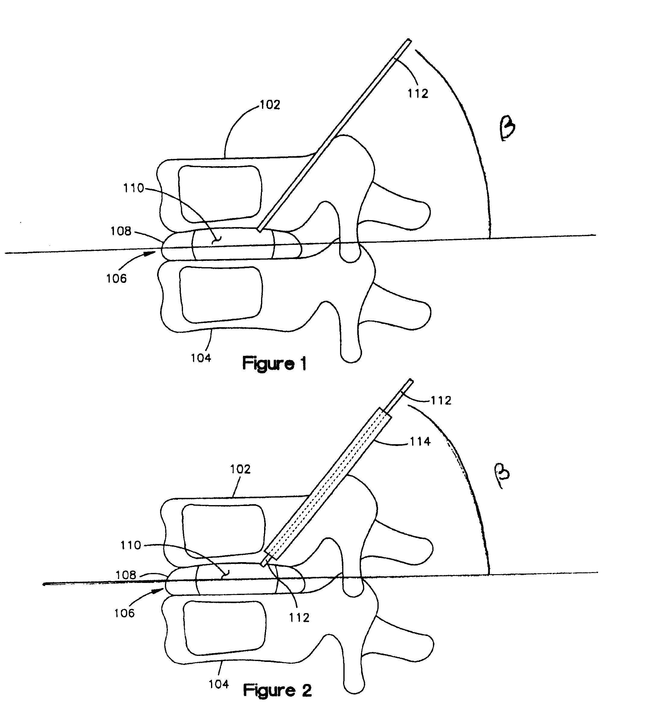 Supplementation or replacement of a nucleus pulposus of an intervertebral disc