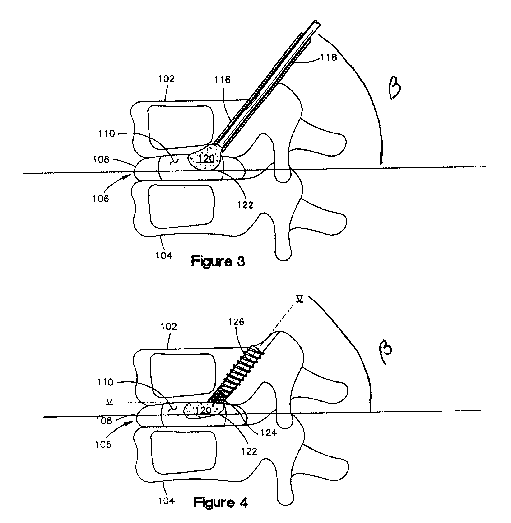 Supplementation or replacement of a nucleus pulposus of an intervertebral disc