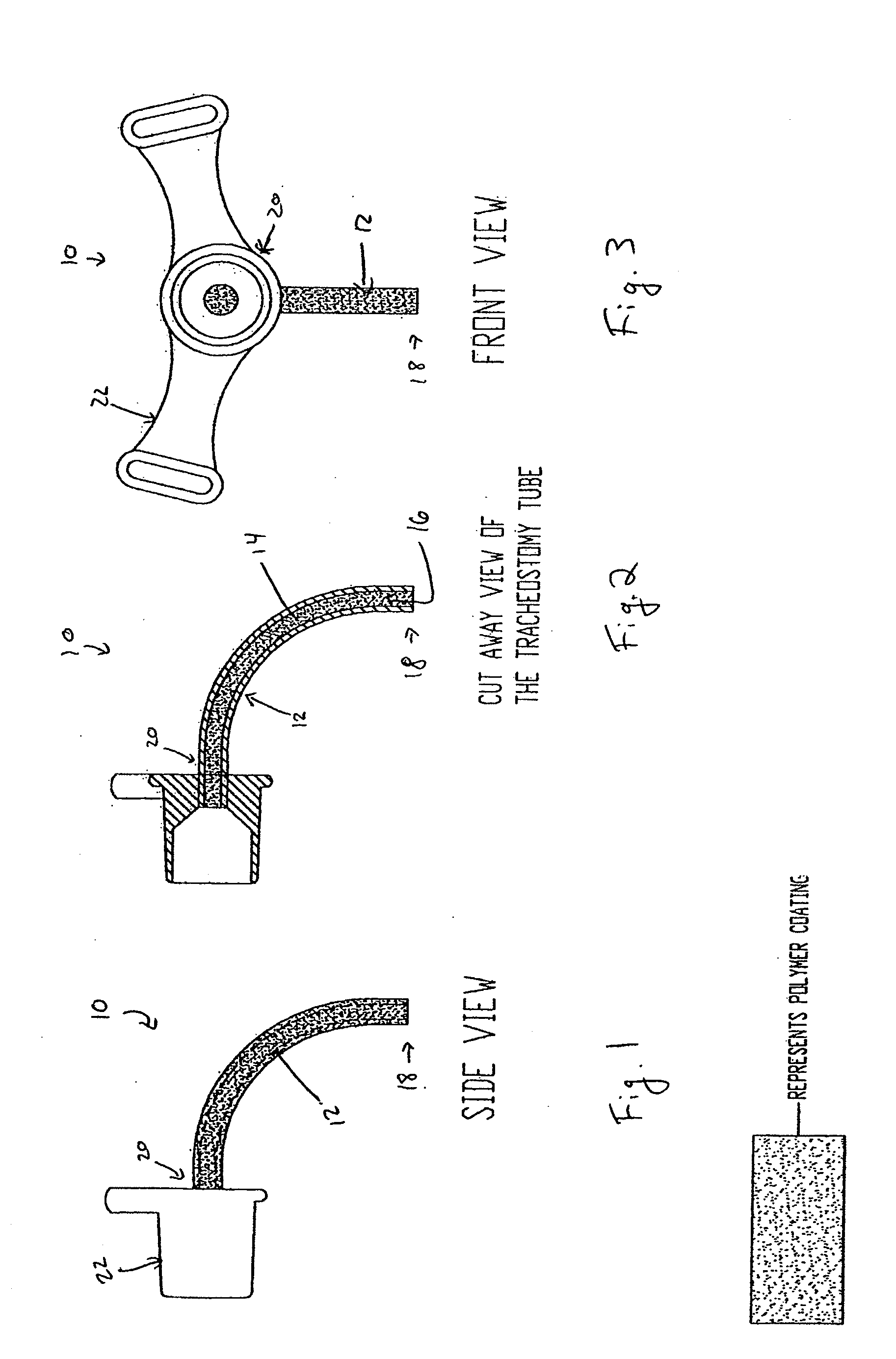 Coated Tracheostomy Tube and Stoma Stent or Cannula