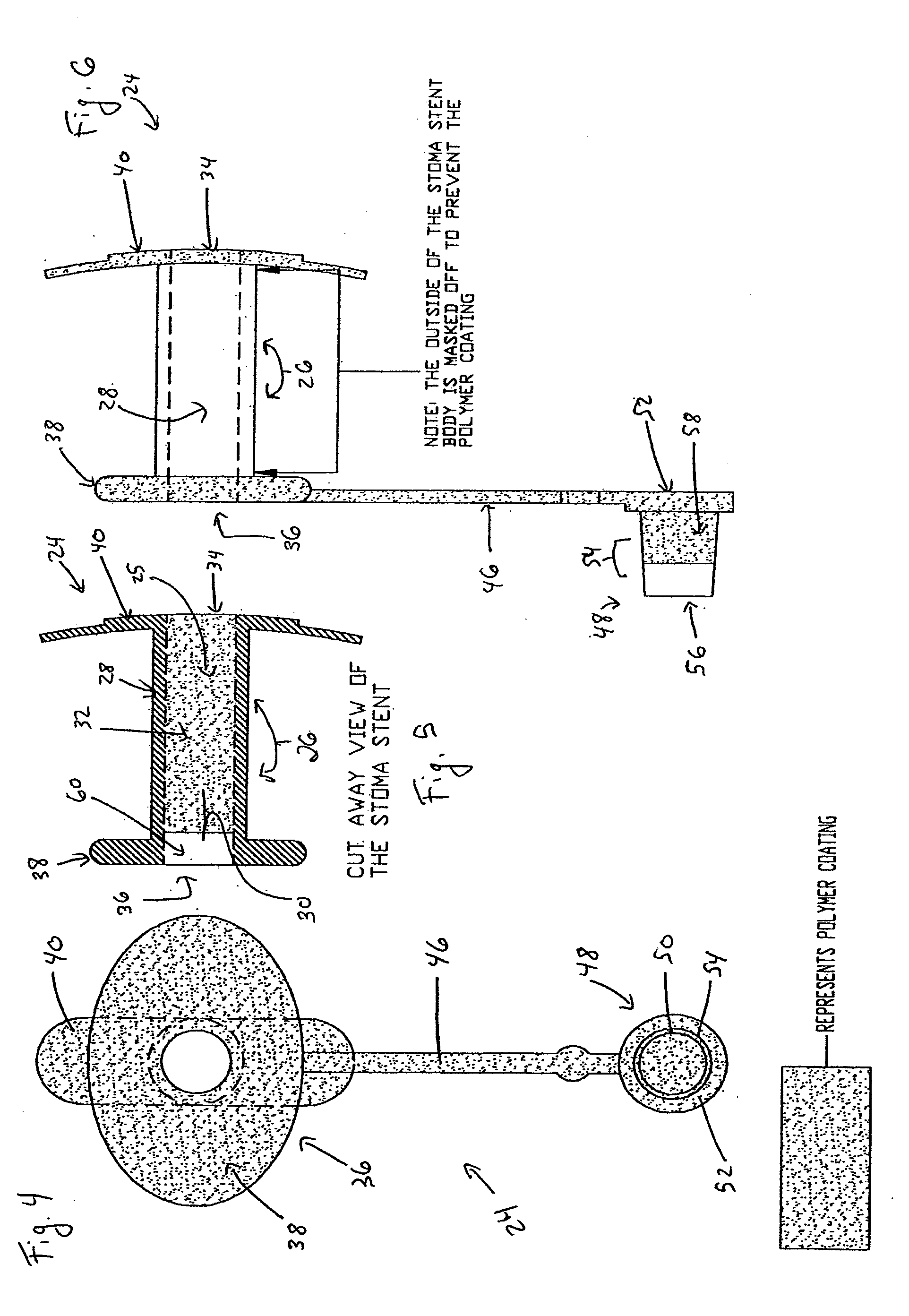 Coated Tracheostomy Tube and Stoma Stent or Cannula