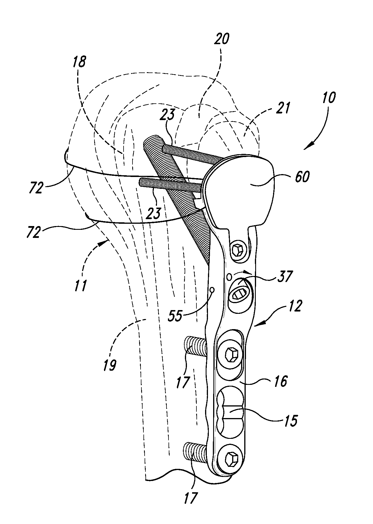 Device for the ostheosynthesis of proximal humerus fractures