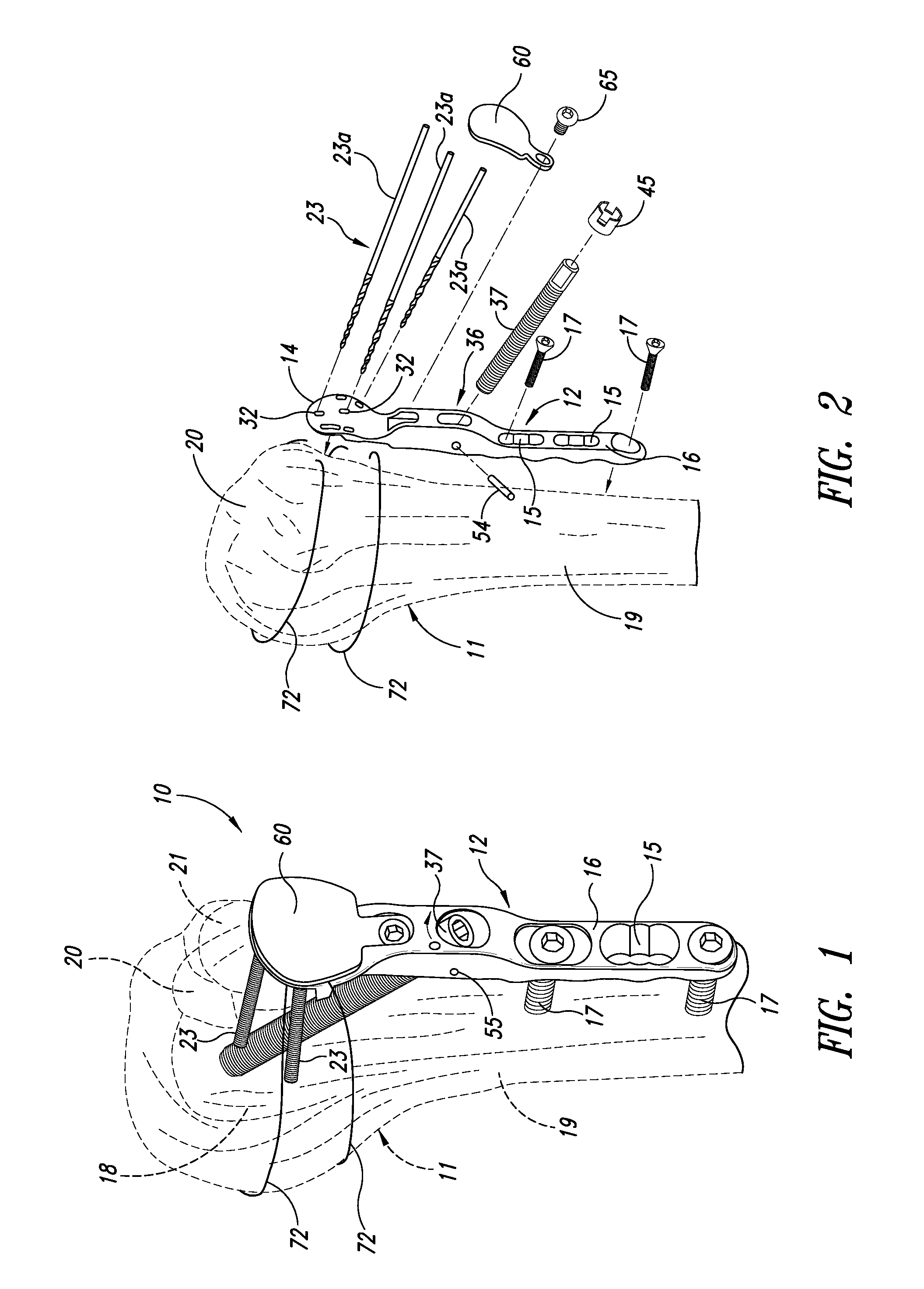 Device for the ostheosynthesis of proximal humerus fractures