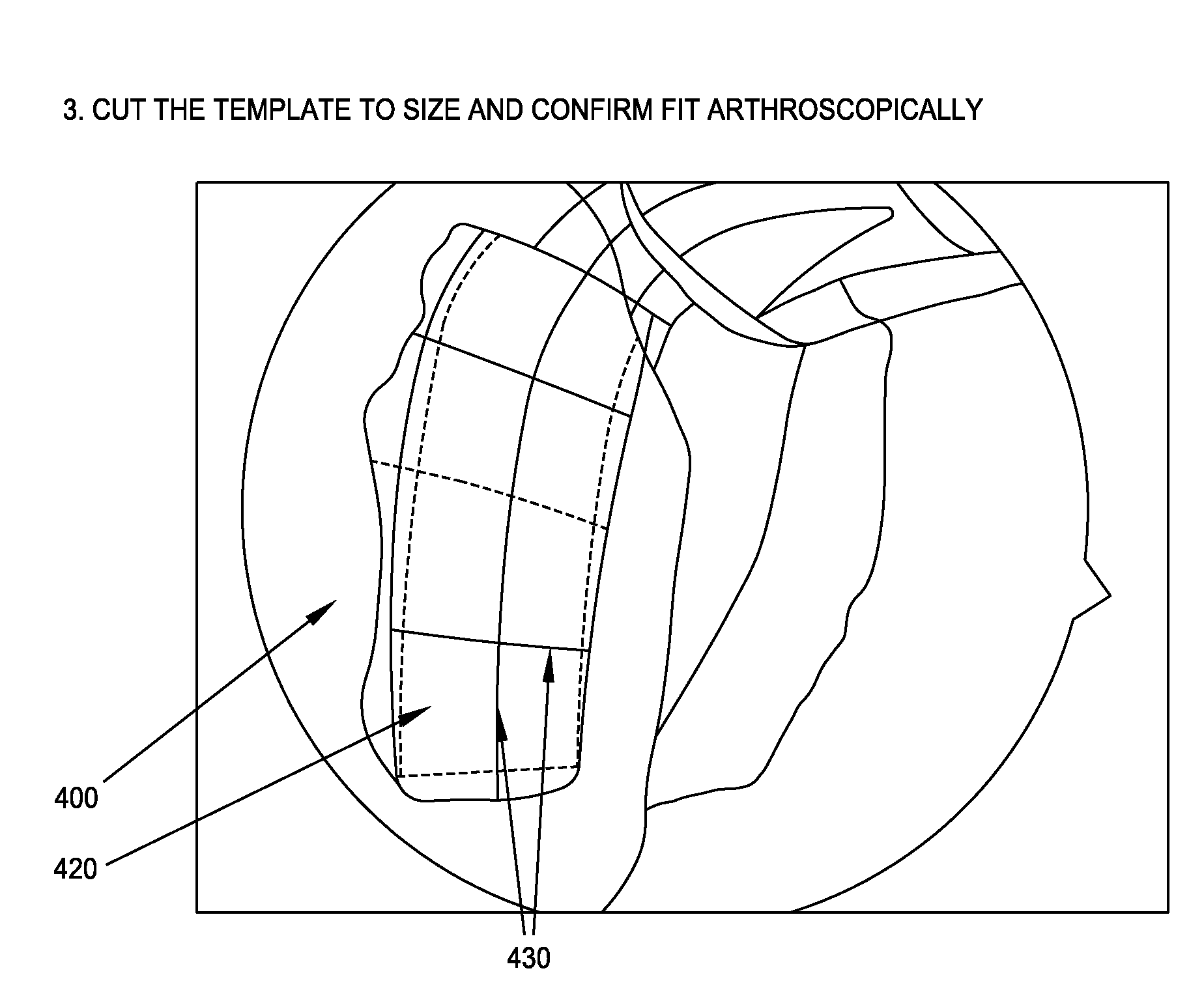 Method and apparatus for restoring articular cartilage