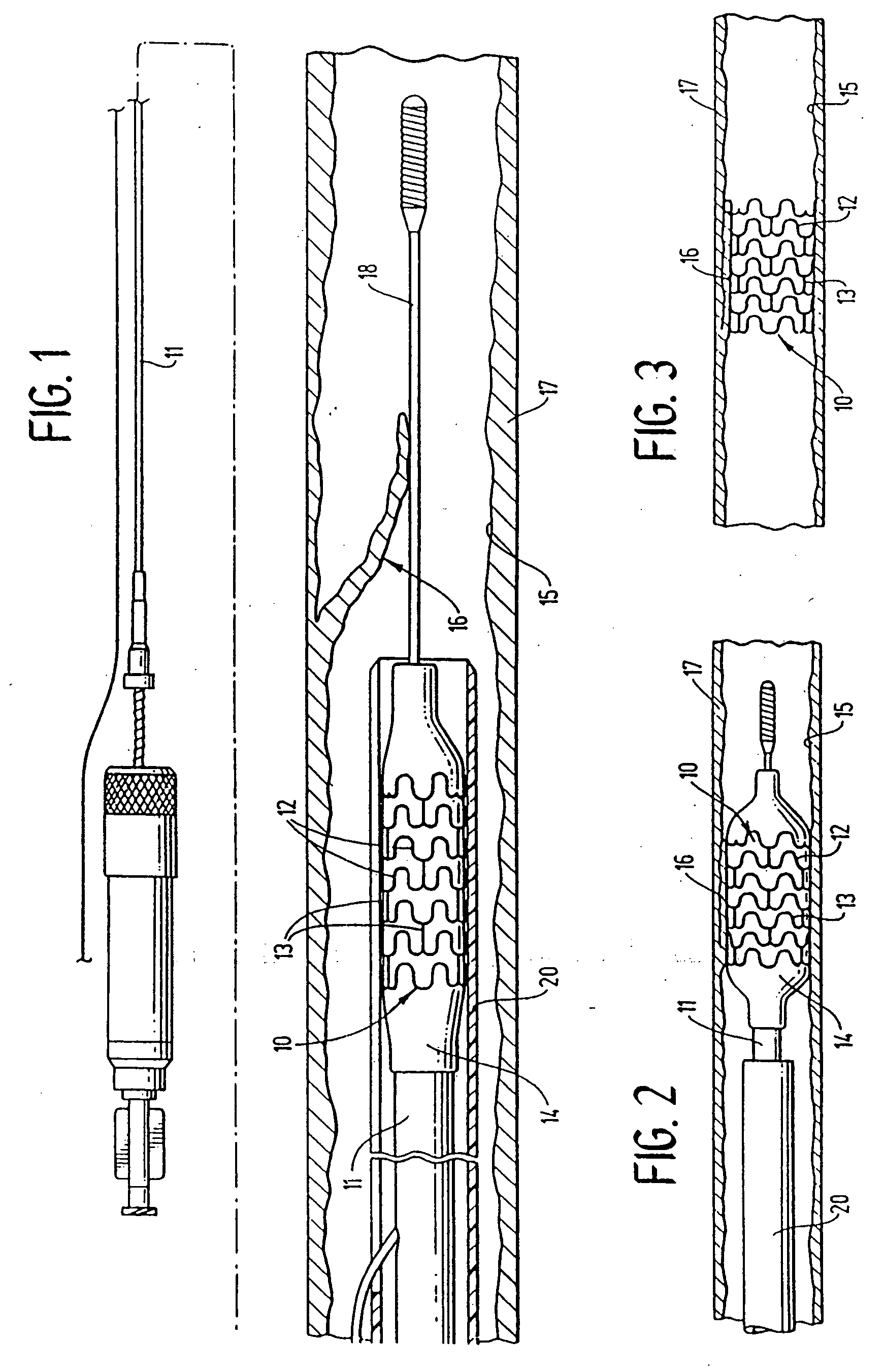 Expandable stents and method for making same