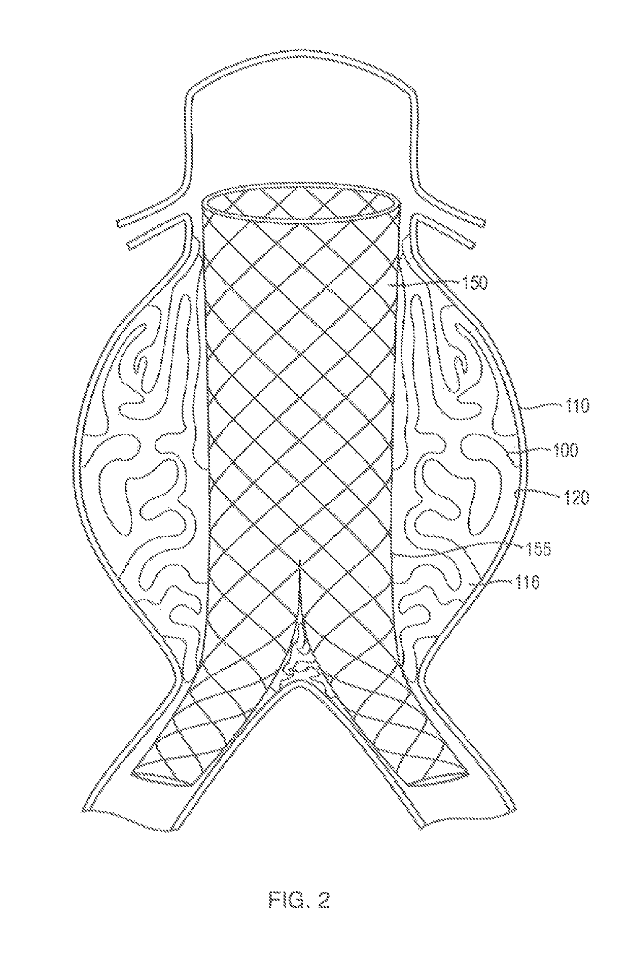 In-situ forming foams for treatment of aneurysms