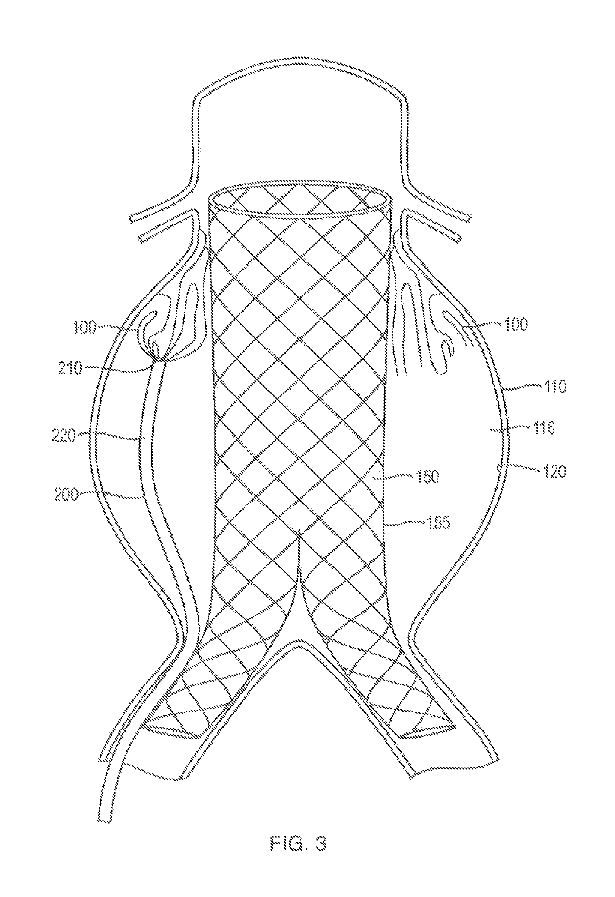 In-situ forming foams for treatment of aneurysms