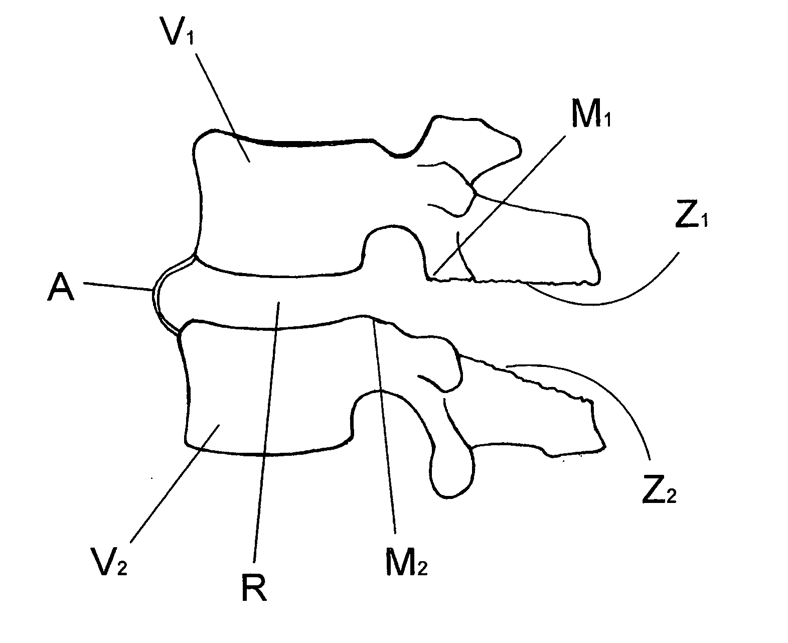 Method for correcting a deformity in the spinal column and its corresponding implant