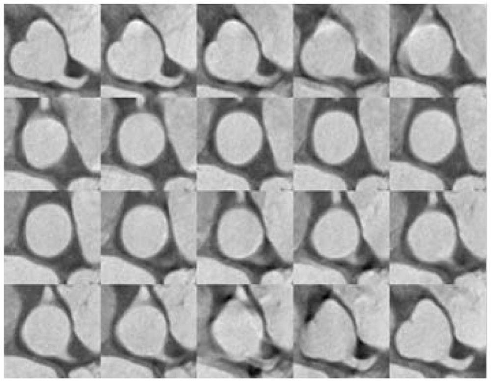 A method for measuring anatomical features of aortic complex