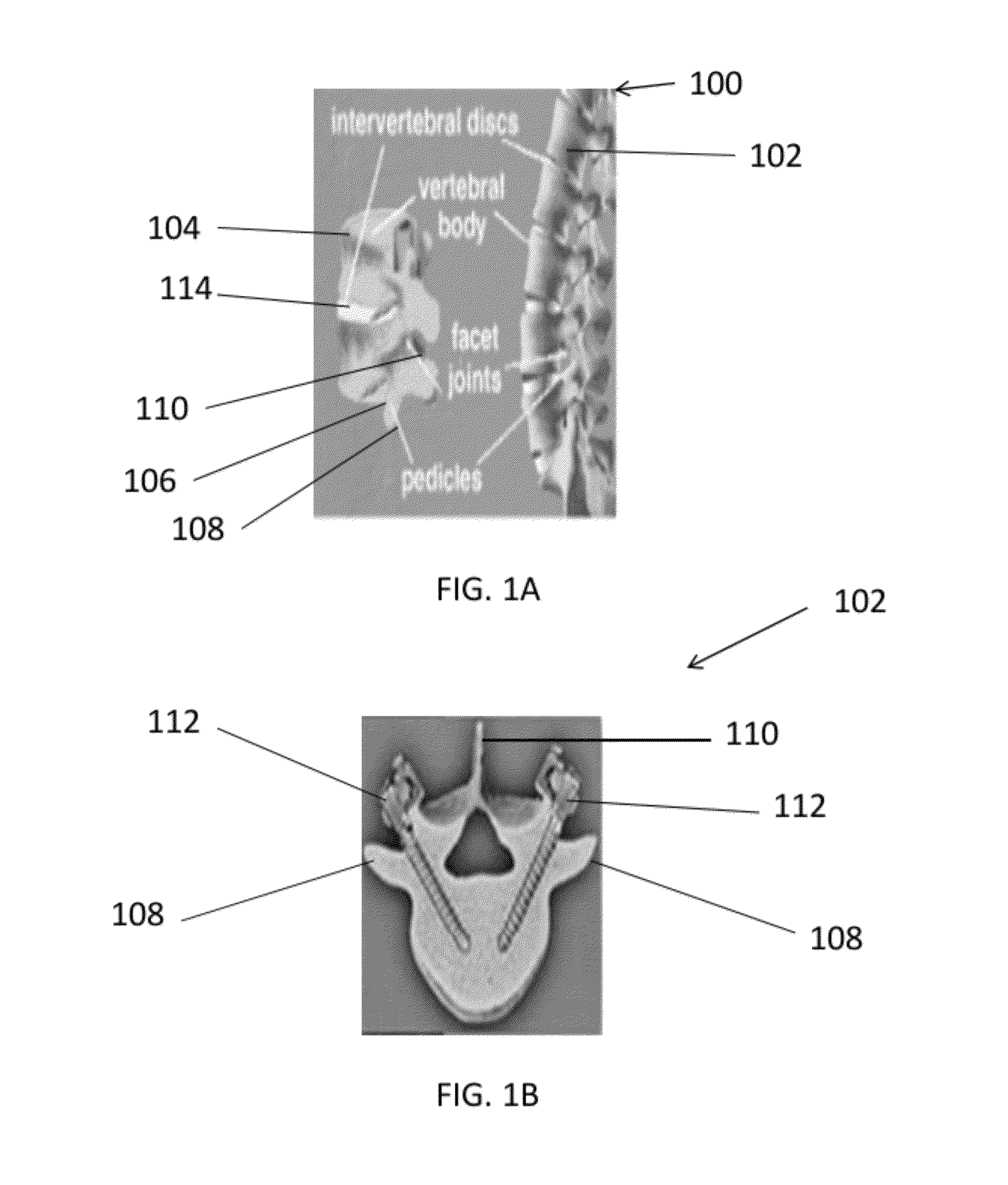 Surgical navigation for revision surgical procedure