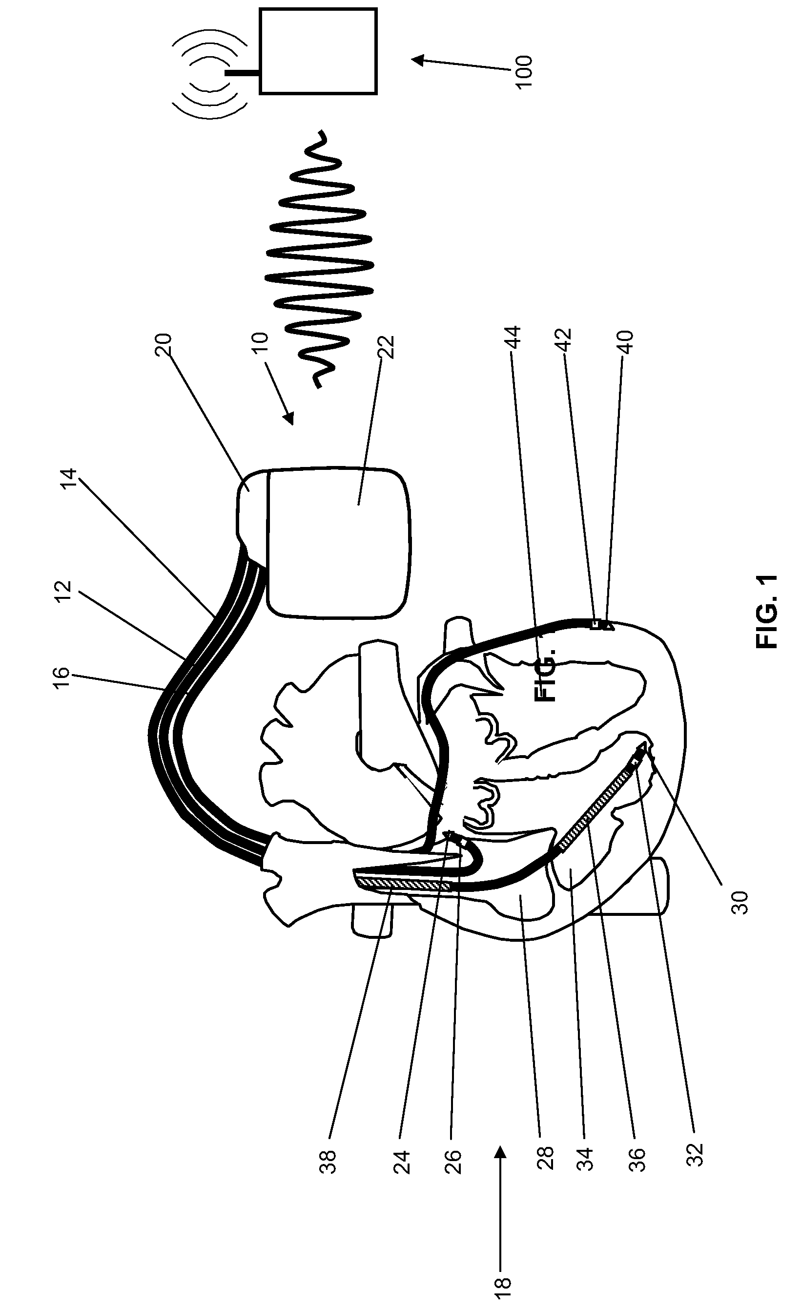 Cardiac stimulator with stimulation success monitoring