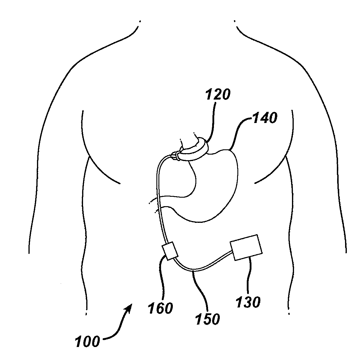 Controlling pressure in adjustable restriction devices