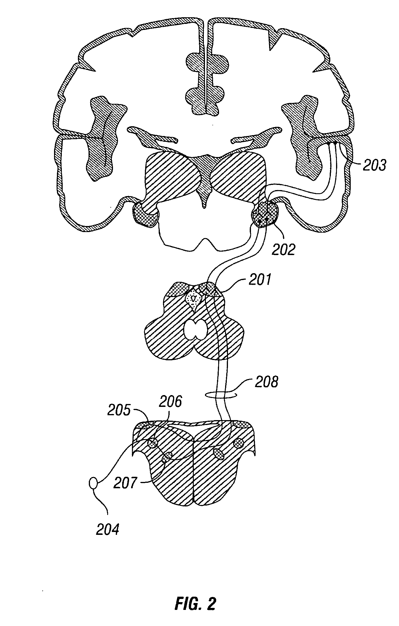 Peripheral nerve stimulation to treat auditory dysfunction