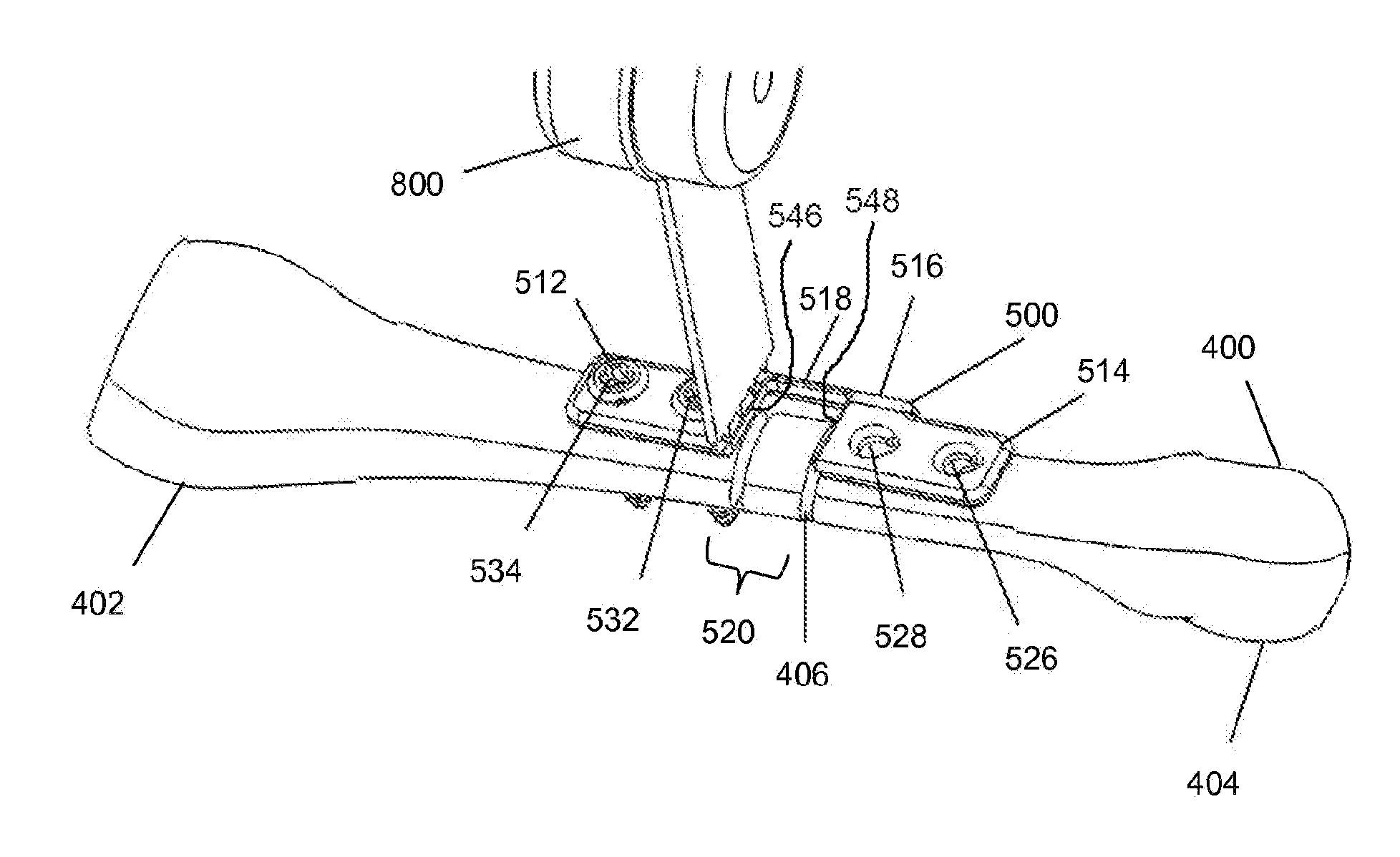 Bone shortening device and method