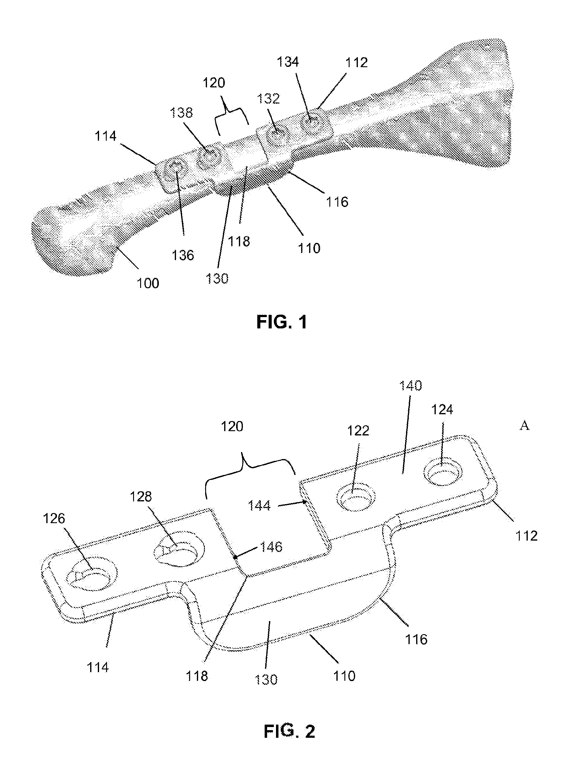 Bone shortening device and method