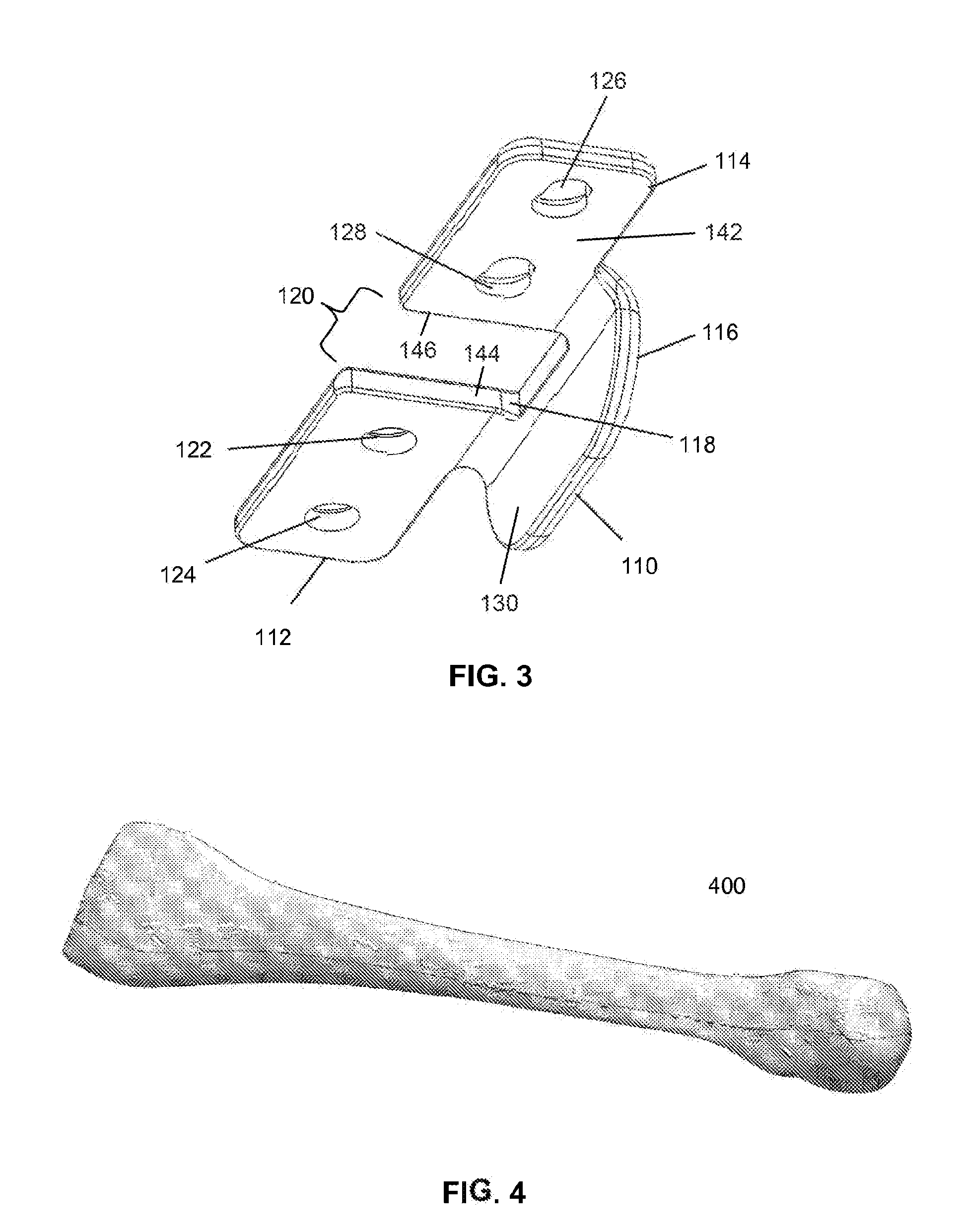 Bone shortening device and method