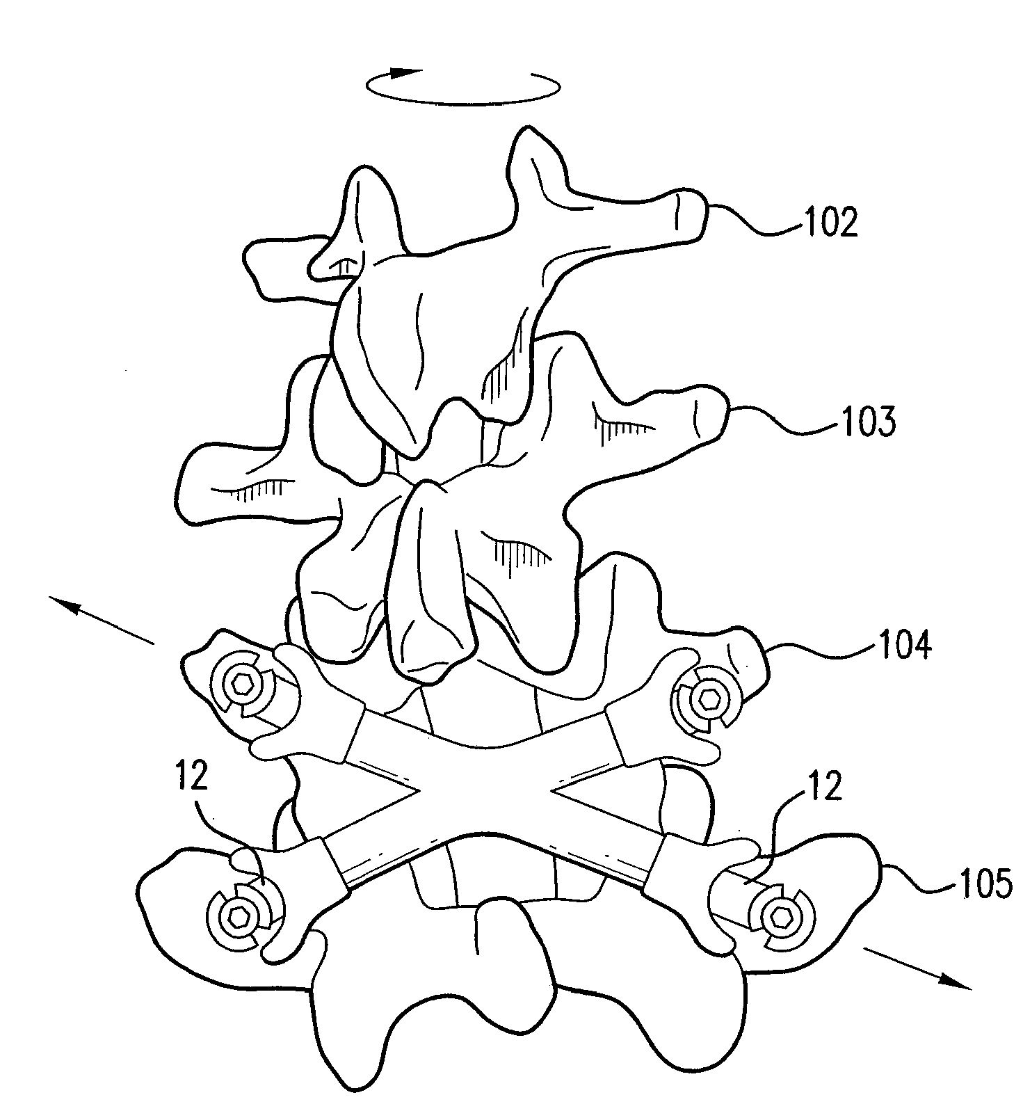 Dynamic spinal stabilization device