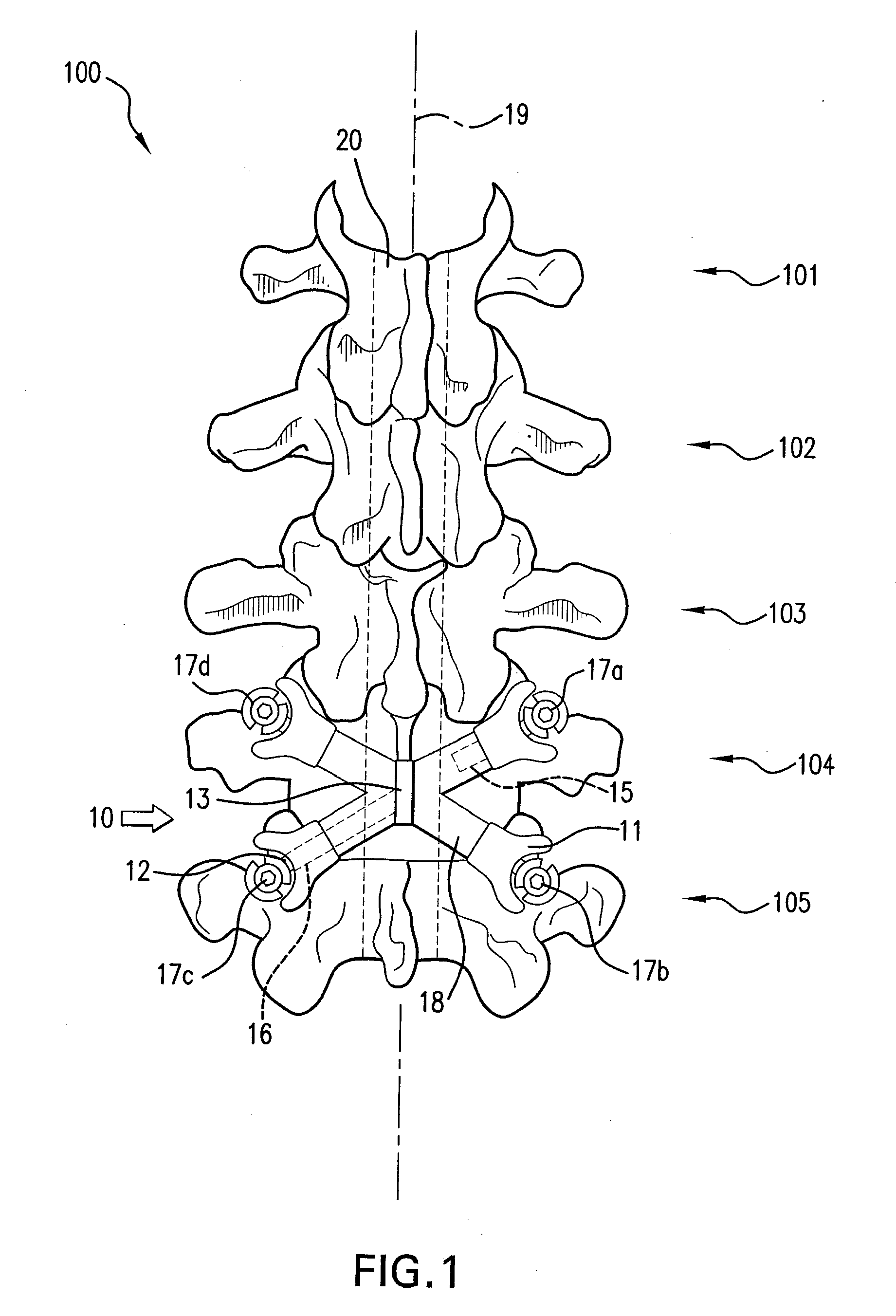 Dynamic spinal stabilization device