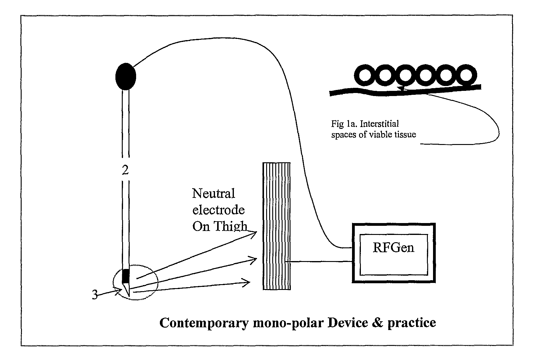 Minimal Device and Method for Effecting Hyperthermia Derived Anesthesia