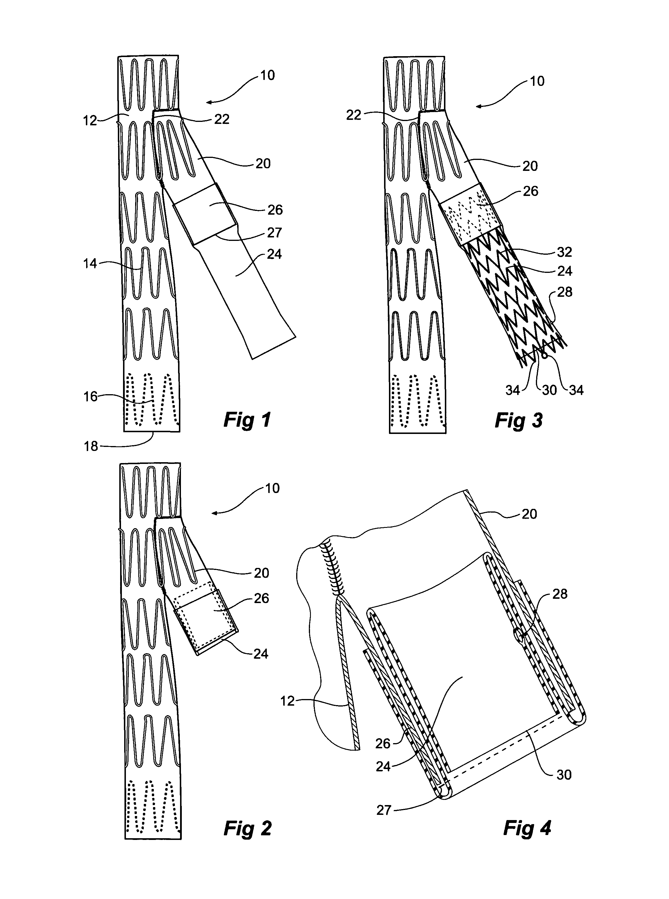 Branch vessel stent graft